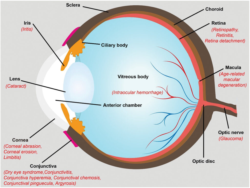 Expected complications after cataract surgery
