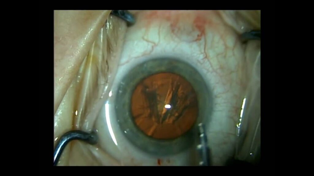 Here is what cataract surgery is?